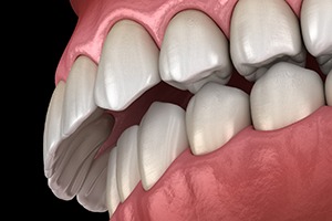 Close-up illustration of an overbite