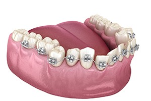 Illustration of metal braces on crooked teeth