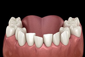 Illustration of crowded teeth viewed from the front