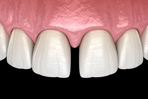 Illustration of gap between two front teeth