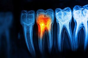 Infected tooth highlighted on x-ray